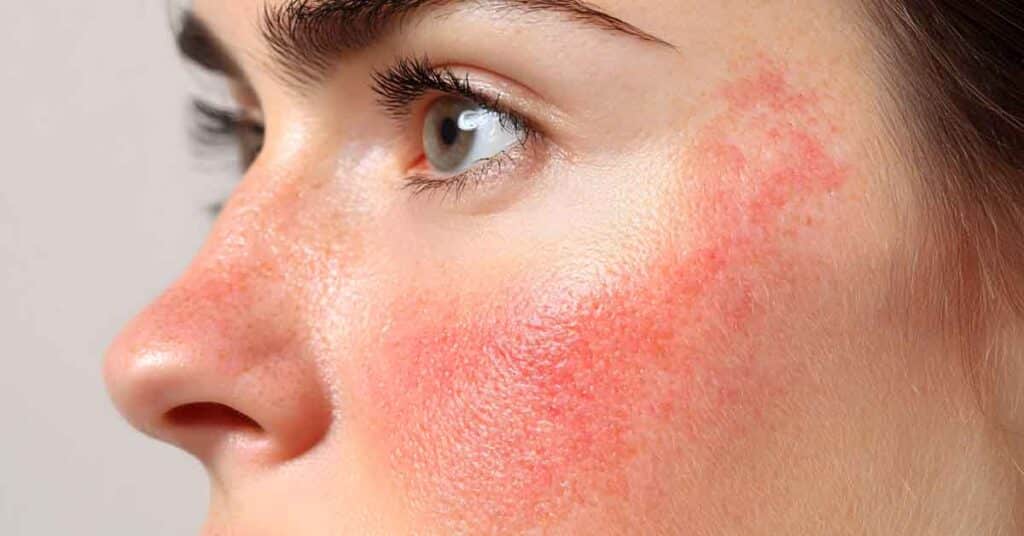 Rosácea: sintomas, causas e tratamentos eficazes
