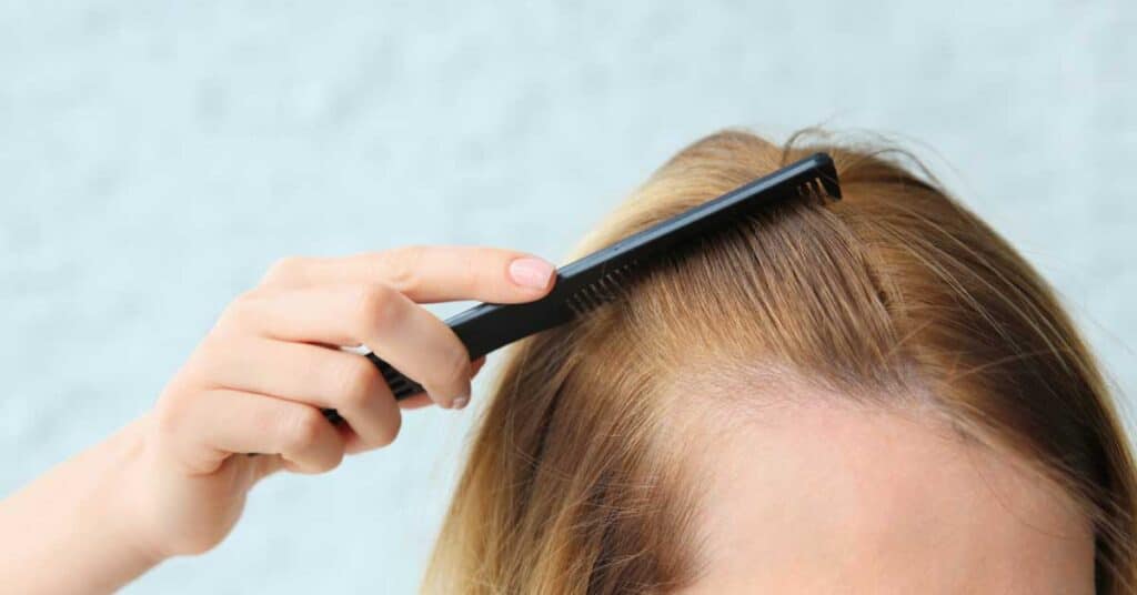12 tratamentos para alopecia mais Eficazes: qual funciona melhor?