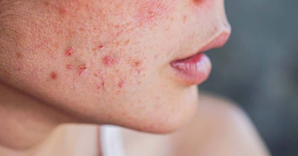 Acne: causas, sintomas e 8 tratamentos eficazes
