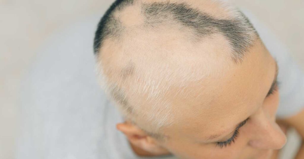 Alopecia areata: como reconhecer os 7 sintomas e tratamentos modernos