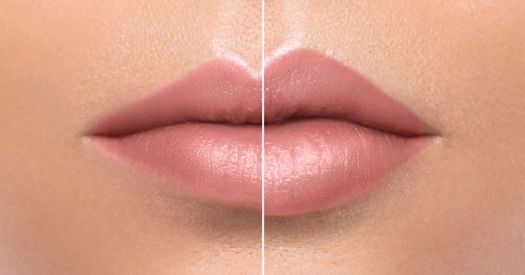 preenchimento labial