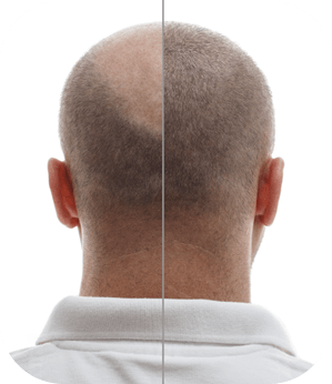 Alopecia