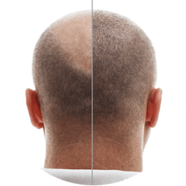 Alopecia