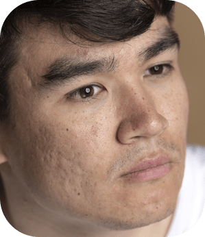 Tratamento de Cicatrizes