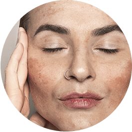 Tratamento do Melasma