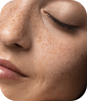 Tratamento do Melasma