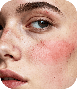 Rosácea