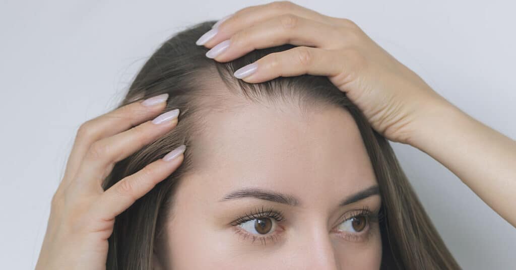 Alopecia feminina: 6 principais causas e como recuperar os cabelos