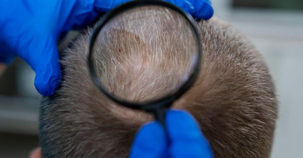 Diagnóstico de alopecia: como é feita a avaliação e quais exames podem ser necessários