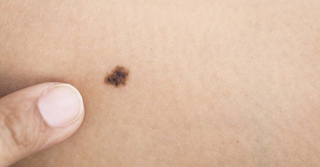Sinais de câncer de pele: quando se preocupar com uma mancha ou ferida